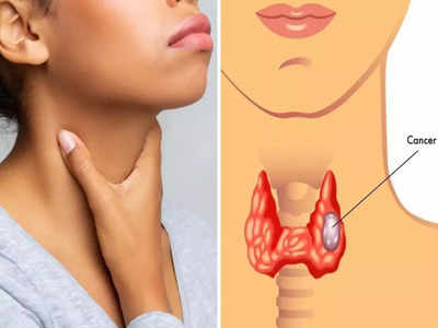 तिशीतल्या मुलींमध्ये वाढतोय जीवघेणा Thyroid Cancer, थकवा-गळ्याचं दुखणं यासारख्या 8 लक्षणांकडे करू नका दुर्लक्ष