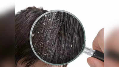 Dandruff treatment: എണ്ണയിട്ടാല്‍ താരന്‍ കൂടുമോ? താരന്‍ അകറ്റാന്‍ ഇതാ ചില മാര്‍ഗങ്ങള്‍