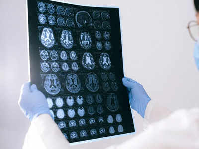 Brain Tumor: തലച്ചോറിലെ മുഴ: ലക്ഷണങ്ങളും കാരണങ്ങളും