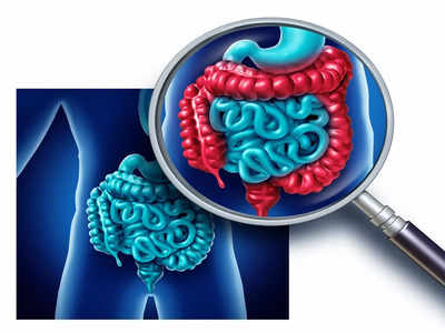 Ulcerative colitis: పేగుపూత ఉన్నవారు.. ఇవి తింటే ప్రమాదం..!