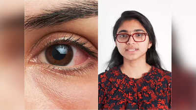 Conjunctivitis Treatment : চোখ ওঠার সমস্যার ঘরোয়া সমাধান, টিপস দিলেন ডা: তসনিম জারা