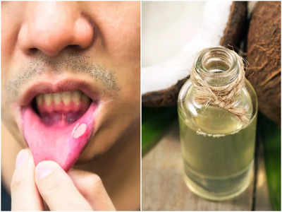 Mouth Ulcer Home Remedy: মুখের আলসারে কষ্ট পাওয়ার দিন শেষ, এবার ঘরোয়া উপায়েই সমস্যা দূর করুন