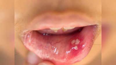 Mouth Ulcer: വായ്പുണ്ണ് മാറ്റിയെടുക്കാന്‍ ഇതാ 5 മാര്‍ഗ്ഗങ്ങള്‍