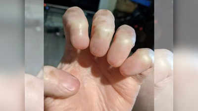 Viral News: एक ऐसी बीमारी जिसमें नाखून ही नहीं आते, हाथ की तस्वीर हुई वायरल