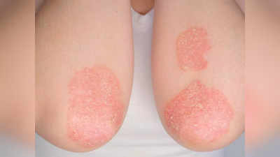 psoriasis: ఇవి తింటే.. సోరియాసిస్‌ లక్షణాలు తగ్గుతాయి..!