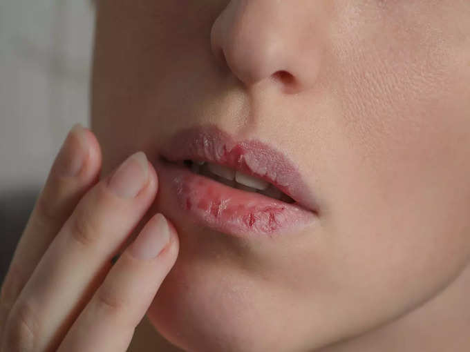 बैक्टीरियल निमोनिया में होठों पर दिखता है लक्षण
