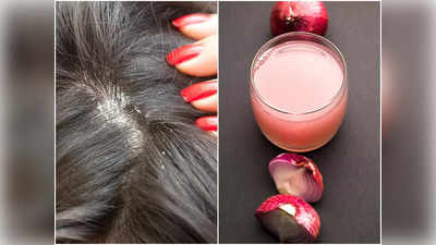 Onion Juice For Dandruff: মাথায় হাত দিলেই ঝরে ঝরে পড়ছে খুশকি? পেঁয়াজের রসের সঙ্গে এই উপাদান মিশিয়ে মাত্র ১ বার লাগান আর ম্যাজিক দেখুন!