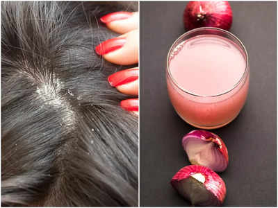 Onion Juice For Dandruff: মাথায় হাত দিলেই ঝরে ঝরে পড়ছে খুশকি? পেঁয়াজের রসের সঙ্গে এই উপাদান মিশিয়ে মাত্র ১ বার লাগান আর ম্যাজিক দেখুন!