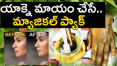 యాక్నె మాయం చేసే.. మ్యాజికల్‌ ప్యాక్‌ 