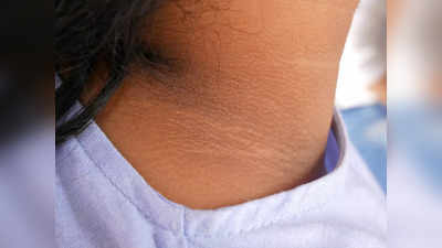 how to remove neck darkness: మెడ నల్లగా మారిందా..? ఈ టిప్స్‌తో మెరిపించండి..!