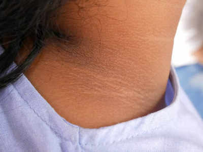 how to remove neck darkness: మెడ నల్లగా మారిందా..? ఈ టిప్స్‌తో మెరిపించండి..!