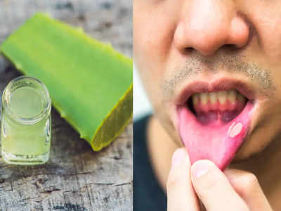 Mouth Ulcer: পেটের তাপ-সহ এই ৫টি মারাত্মক রোগের লক্ষণই মুখের ভিতরের আলসার, এই ৫টি জিনিস খেলে বাঁচবে ডাক্তারের ফি