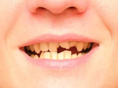 Yellow Teeth Reasons: क्या दांत पीले हो गए हैं? इन 10 बीमारियों की हो सकती है आहट, अंदर से हो जाएंगे खोखले