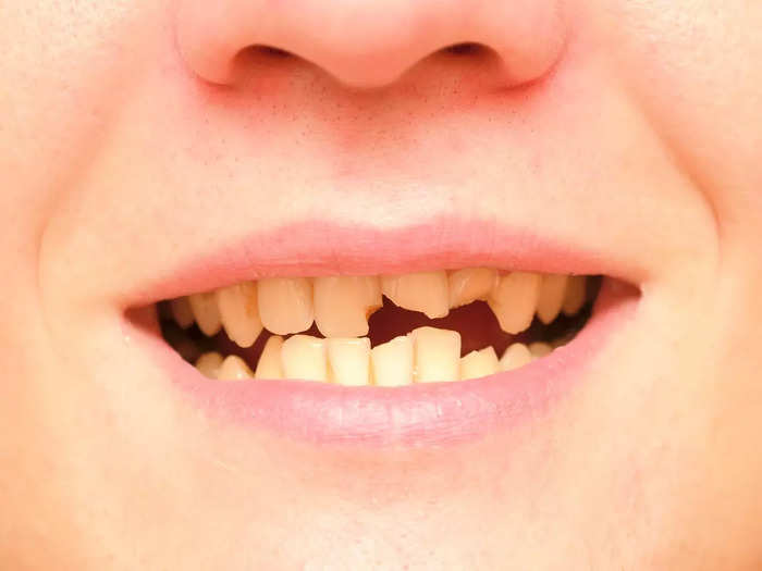 what are the reasons of yellow teeth and teeth discoloration know diseases cause teeth to yellow