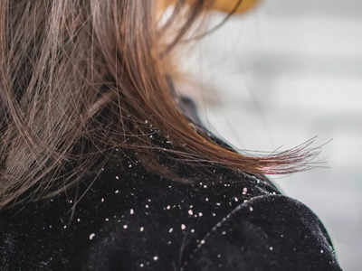 Tips To Remove Dandruff: డ్యాండ్రఫ్‌ వేధిస్తోందా? ఈ టిప్స్‌ ఫాలో అవ్వండి