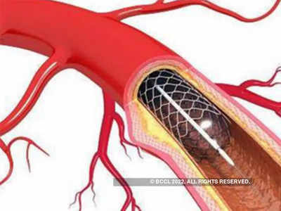 Stents : केंद्र सरकारचा मोठा निर्णय, आवश्यक औषधांच्या यादीत स्टेंटचा समावेश; किंमत होणार स्वस्त