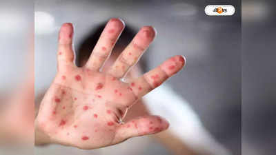 Monkey Pox : মাঙ্কিপক্সের নাম বদল বিশ্ব স্বাস্থ্য সংস্থার, কী বলে চিহ্নিত হবে মারণ ভাইরাস?