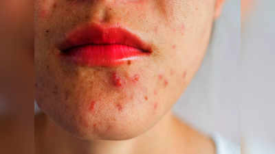 Psoriasis, Eczema, Rosacea जैसे चर्म रोग जड़ से होंगे खत्म, Ayurveda डॉ. ने बताए 6 गजब के नुस्खे