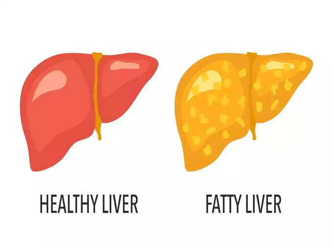 ​கொழுப்பு கல்லீரல் நோயின் நிலைகள் (stages of fatty liver disease)