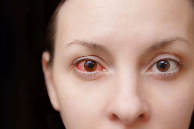 ​இமைப்படல அழற்சியின் வகைகள் (types of Conjunctivitis)