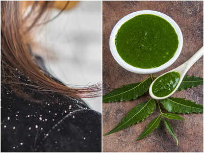 Neem For Dandruff: শীত পড়তেই মাথায় ভরে যাচ্ছে খুশকি? নিম পাতার সঙ্গে এই উপাদান মিশিয়ে মাত্র ১ বার লাগিয়ে দেখুন