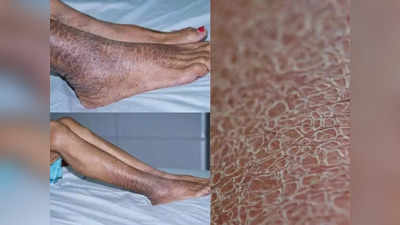 Ichthyosis:കൈകളിലും കാലുകളിലും മൊരി, പരിഹാര വഴികള്‍