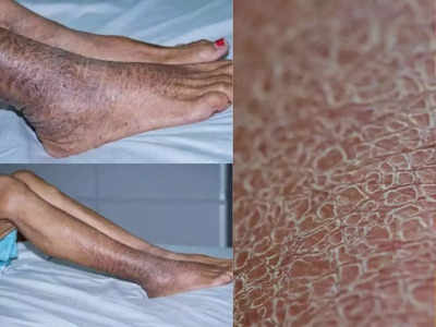 Ichthyosis:കൈകളിലും കാലുകളിലും മൊരി, പരിഹാര വഴികള്‍