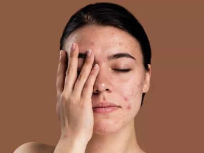 Skin Care in Winter: શિયાળામાં ડ્રાયનેસના કારણે થતાં ચામડીના રોગોને દૂર કરશે આયુર્વેદિક ડોક્ટરના 6 ઘરેલૂ નુસખા