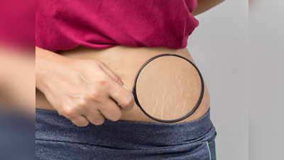 How to get rid of stretch marks: ఈ టిప్స్‌ ఫాలో అయితే.. స్ట్రెచ్‌మార్క్స్‌ దూరం అవుతాయి..!