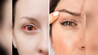 Eye Twitching : शगुन-अपशगुन का संकेत नहीं, बार-बार आंखें फड़कने की असली वजह हैं ये 3 गंभीर बीमारी