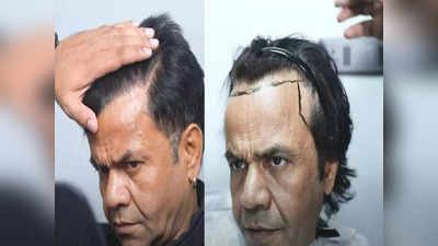 Rajpal Yadav Hair Transplant : Rajpal Yadavએ હેર ટ્રાન્સપ્લાન્ટ કરાવ્યું, અનુભવ શેર કરતાં જણાવ્યું કઈ વાતનો લાગી રહ્યો હતો ડર?