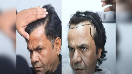 Rajpal Yadav Hair Transplant : Rajpal Yadavએ હેર ટ્રાન્સપ્લાન્ટ કરાવ્યું, અનુભવ શેર કરતાં જણાવ્યું કઈ વાતનો લાગી રહ્યો હતો ડર? 