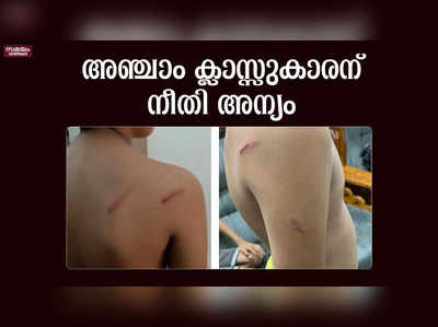 സീനിയർ വിദ്യാർത്ഥികളുടെ ക്രൂരമർദ്ദനം  അഞ്ചാം ക്ലാസ്സുകാരന് നീതി അന്യം 