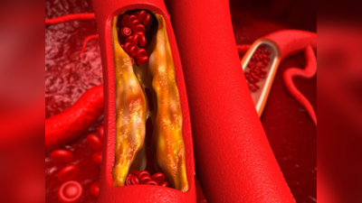 high cholesterol : உயர் கொலஸ்டிரால் அறிகுறிகள் என்ன... அது யாருக்கெல்லாம் வரும்...