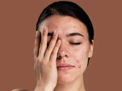 Acne Remedies: ખીલ, એક્ને+તેના ડાઘ કાયમી દૂર કરશે રસોડાંની 3 સસ્તી વસ્તુઓ; આયુર્વેદિક વૈદ્યની ટિપ્સ