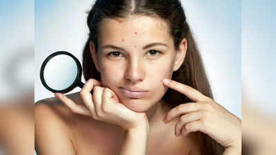 forehead acne problem : பருக்கள் நெற்றியில் வர என்ன காரணம்? வேகமாக மறைய என்ன செய்யணும்...