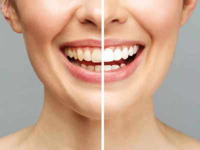 Teeth Whitening Powder: ડેન્ટિસ્ટના ભારેખમ બિલથી બચો, ઘરે માત્ર 20 રૂ.માં બનાવો આયુર્વેદિક પાઉડર; દાંત બનશે દૂધ જેવા સફેદ 