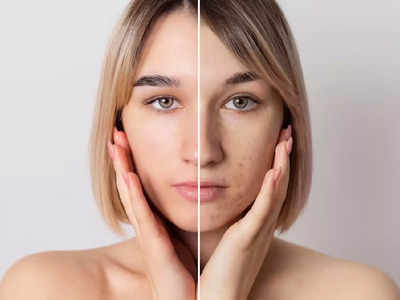 Anti Pigmentation Cream: चेहरे पर मौजूद दाग को कर सकती हैं साफ, महीने भर में मिलेगी स्पॉटलेस हेल्दी स्किन