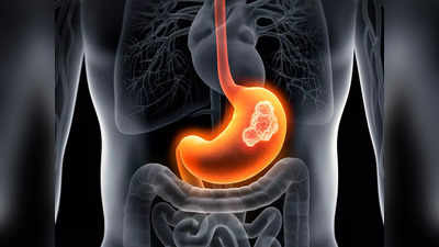 Diet for Gastric Cancer: ఈ డైట్‌ తీసుకుంటే.. గ్యాస్ట్రిక్‌ క్యాన్సర్‌ ముప్పు తగ్గుతుంది..!