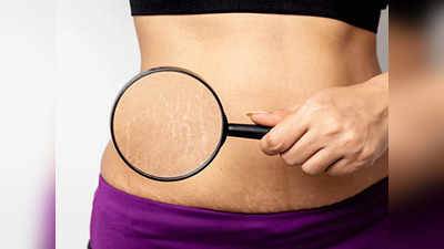 Stretch Marks से प्रेगनेंसी के बाद पाना चाहती हैं छुटकारा तो आजमाएं ये आसान तरीके और पाएं स्मूद स्किन