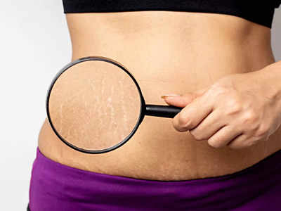 Stretch Marks से प्रेगनेंसी के बाद पाना चाहती हैं छुटकारा तो आजमाएं ये आसान तरीके और पाएं स्मूद स्किन