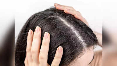 Hair packs for Dandruff: താരൻ അകറ്റാൻ വീട്ടിൽ എളുപ്പത്തിൽ ചെയ്യാൻ കഴിയുന്ന രണ്ട് പാക്കുകളിതാ