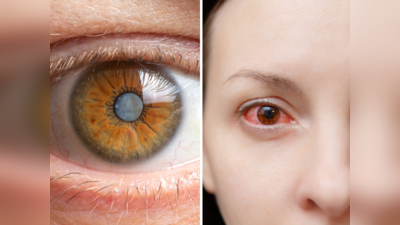 Cataract Symptoms: कई साल पहले दिख जाता है मोतियाबिंद का ये लक्षण, नजर रखेंगे तो नहीं करवानी पड़ेगी सर्जरी