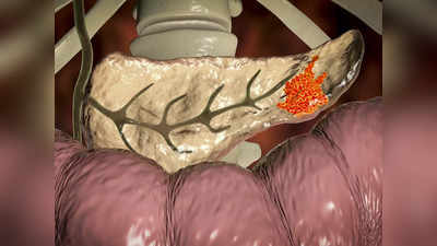 Pancreatic Cancer Symptoms: অগ্ন্যাশয়ের ক্যানসার চুপি চুপি প্রাণ কাড়তে পারে! লক্ষণ জেনে নিজেকে বাঁচান