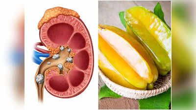 Worst Foods For Kidney Stones: কিডনিতে পাথর হলে এই ৫ খাবার ভুলেও ছোঁবেন না, ভিতর ভিতরই বাড়তে থাকবে রোগ