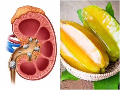 Worst Foods For Kidney Stones: কিডনিতে পাথর হলে এই ৫ খাবার ভুলেও ছোঁবেন না, ভিতর ভিতরই বাড়তে থাকবে রোগ