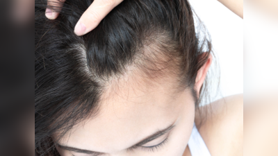 Hair loss: ನೆತ್ತಿಯ ಭಾಗದ ಕೂದಲು ಉದುರಿ ಬೋಳಾಗುವ  ಮೊದಲು ಇದನ್ನು ಟ್ರೈ ಮಾಡಿ
