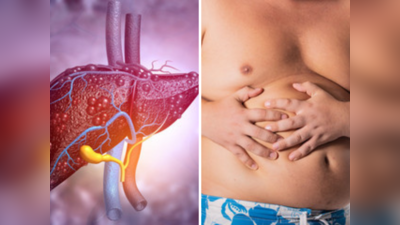 Fatty Liver: अतिरिक्त चरबीमुळे होतेय लिव्हरचे नुकसान, नॉन-अल्कोहोलिक फॅटी लिव्हर आणि लठ्ठपणाच्या आजारात वाढ