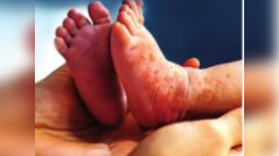 मुंबईत नऊ महिन्यांच्या बाळाचा गोवरने मृत्यू; अहवालानंतरच नेमकं कारण स्पष्ट