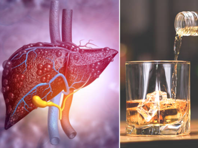 अल्कोहल से सड़ने लगे Liver तो दिखते हैं ये 6 शुरुआती लक्षण, जानें कितनी मात्रा के बाद शराब बन जाती है जहर